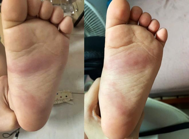 Hưng Yên: Xác minh phản ánh trẻ 3 tuổi bị bầm tím chân sau khi ở trường mầm non về